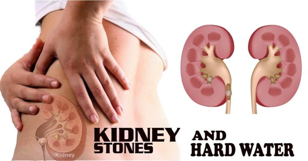 Is Drinking Hard Water Bad for Your Kidneys?